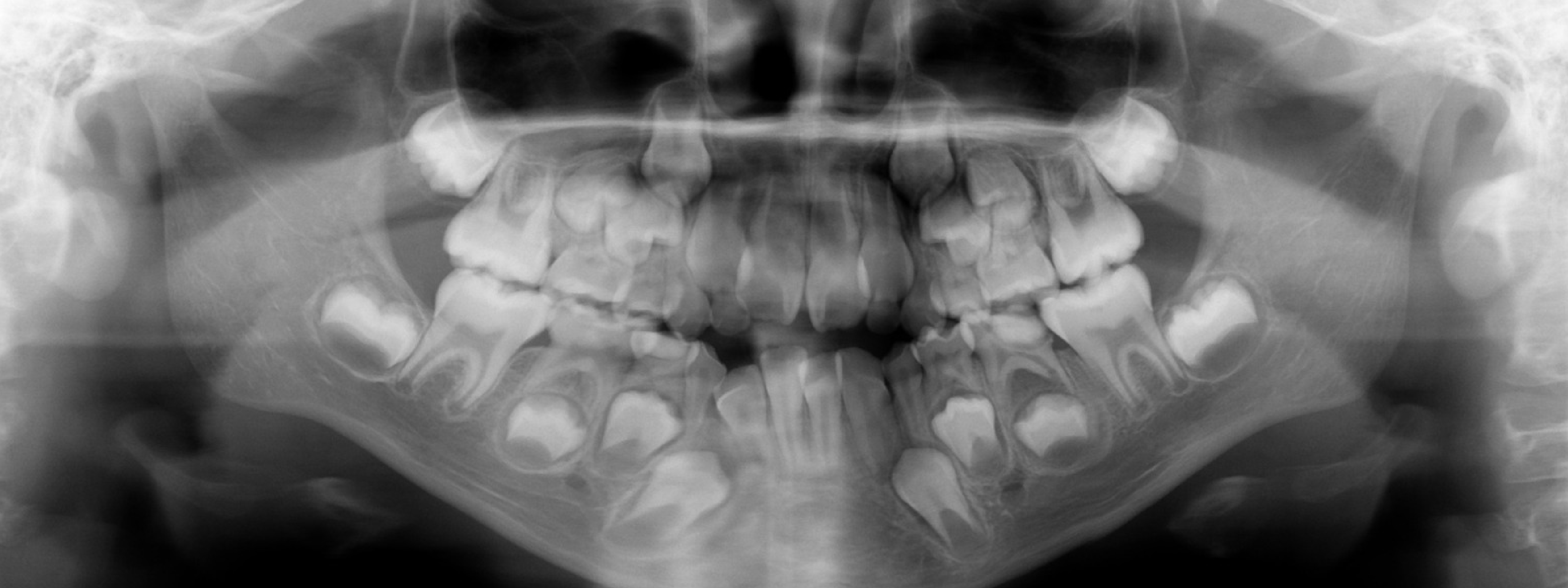 Radiografía Intrabucal